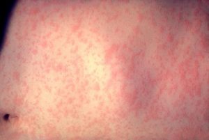 Recent travellers warned after measles case passed through Melbourne Airport